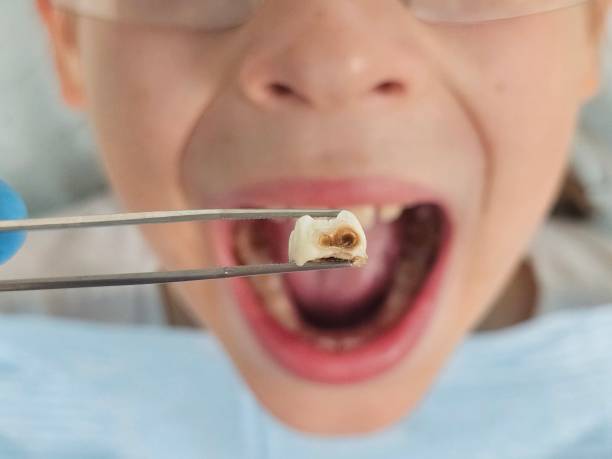Best Emergency Tooth Extraction  in Carey, OH