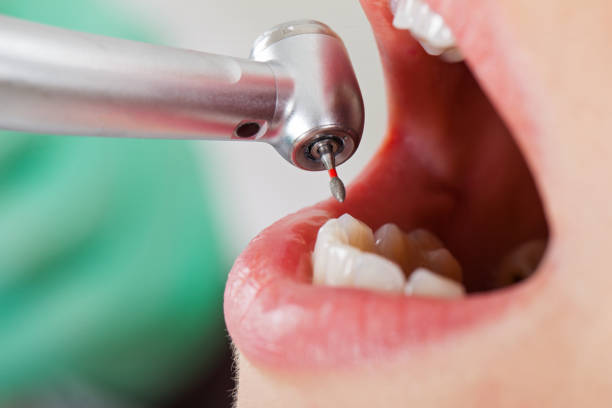 Best Broken Tooth Emergency  in Carey, OH